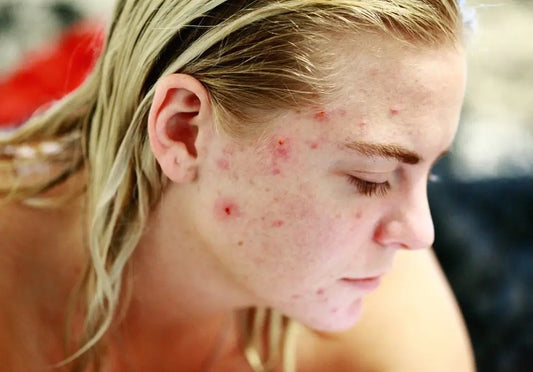 Shingles Outbreak