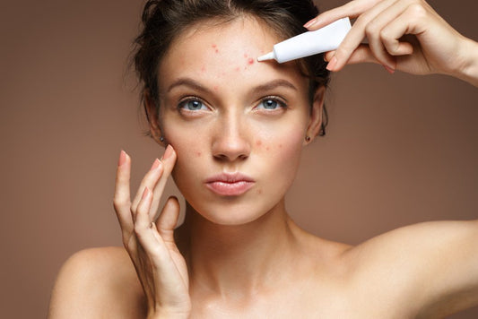 Acne Myths