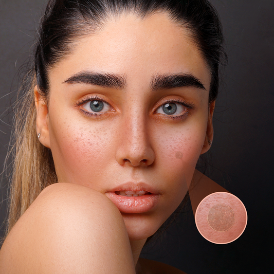 Understanding the Science Behind Hydrocolloid Patches for Acne
