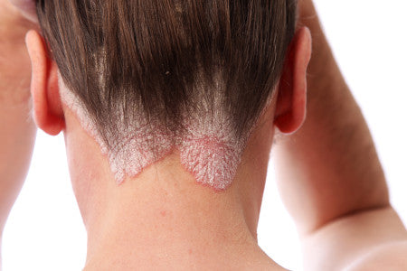 Itchy Scalp