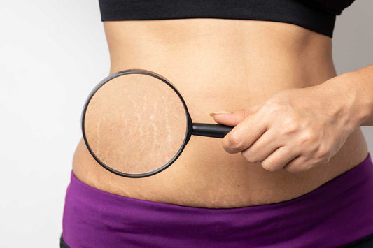 Shingles Cream for stretchmarks treatment