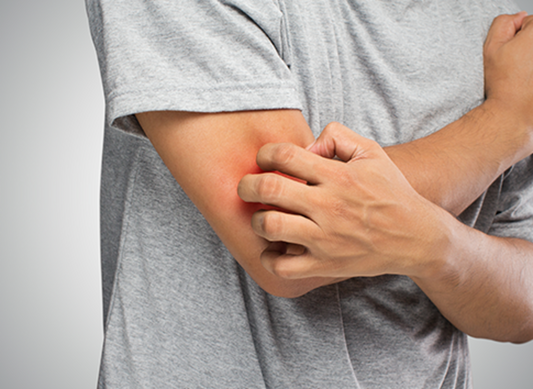 Shingles: Symptoms, Causes, Treatment, and Prevention, According to Experts