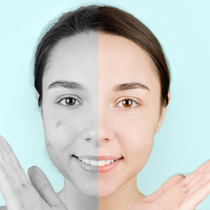 Hydrocolloid Acne Patches
